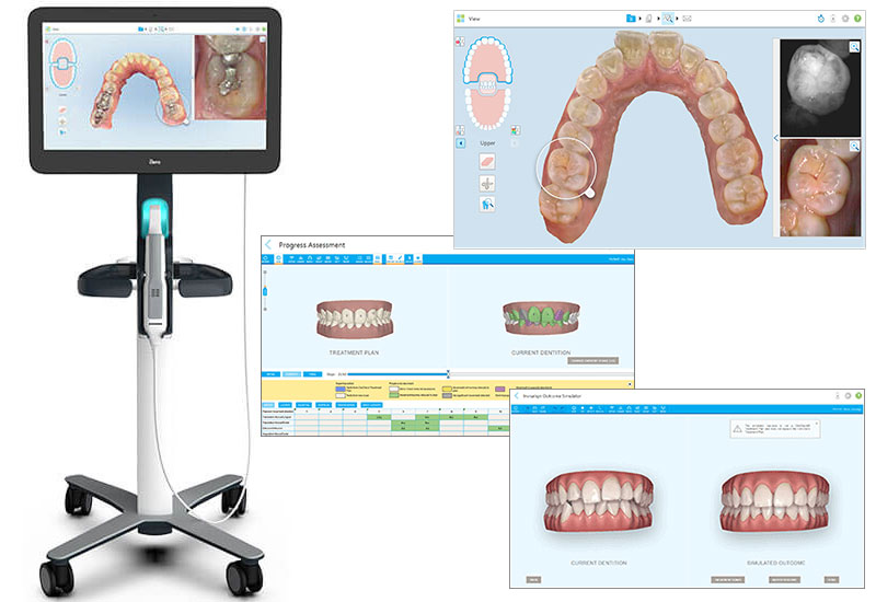 口腔内光学スキャナ iTero(アイテロ)