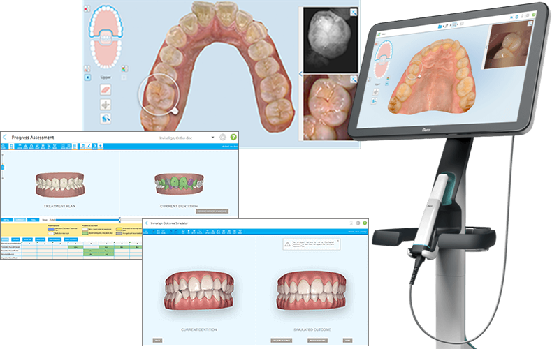 口腔内光学スキャナiTero完備